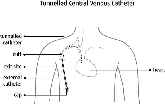 Area / Lokasi penempatan CVC atai kateter vena sentral